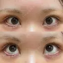 タレ目形成・グラマラスライン（切開） 形成外科と美容外科のクリニック池袋 DAY 9 サムネイル用