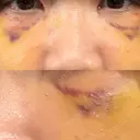 クマ治療 池袋麗歯科・美容皮膚科 DAY 10 サムネイル用