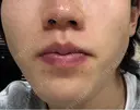 イオン導入 Kinshicho Beauty Clinic （錦糸町ビューティークリニック） DAY 9 サムネイル用