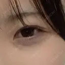 クマ治療 PureMe Skin Clinic（ピュアミースキンクリニック麻布） AFTER サムネイル用