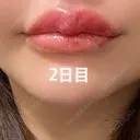 アートメイク（唇） / アートメイク（アイライン） Kinshicho Beauty Clinic （錦糸町ビューティークリニック） DAY 2 サムネイル用