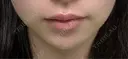 ボトックス（口角） TCB東京中央美容外科 京都駅前院 DAY 44 サムネイル用