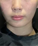 糸リフト / ボトックス（あご） / ヒアルロン酸注入（あご） / ヒアルロン酸注入（頬） Wing clinic 豊中駅前院 DAY 0 サムネイル用