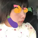 鼻尖形成（切開） / 小鼻縮小（切開） / 軟骨移植 / 眉間プロテーゼ 湘南美容クリニック 熊本院 DAY 34 サムネイル用