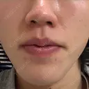 イオン導入 Kinshicho Beauty Clinic （錦糸町ビューティークリニック） AFTER サムネイル用