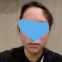 糸リフト / 脂肪吸引（顔） / ジョールファット除去 / 脂肪吸引注射（顔） SEA CLINIC（シークリニック） DAY 4 サムネイル用