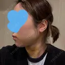 糸リフト / 脂肪吸引（顔） / ジョールファット除去 / 脂肪吸引注射（顔） SEA CLINIC（シークリニック） DAY 4 サムネイル用