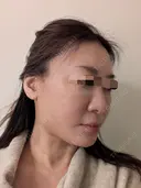 糸リフト / 脂肪吸引（顔） Wing clinic 豊中駅前院 DAY 4 サムネイル用