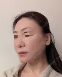 糸リフト / 脂肪吸引（顔） Wing clinic 豊中駅前院 DAY 4 サムネイル用