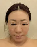 糸リフト / 脂肪吸引（顔） Wing clinic 豊中駅前院 DAY 6 サムネイル用