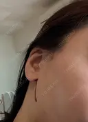 糸リフト / 脂肪吸引（顔） Wing clinic 豊中駅前院 DAY 6 サムネイル用