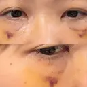 クマ治療 池袋麗歯科・美容皮膚科 DAY 12 サムネイル用