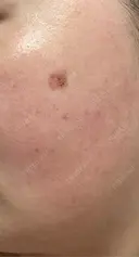 その他（肌） / シミ取りレーザー / ルメッカ ルラ美容クリニック 郡山院 DAY 12 サムネイル用