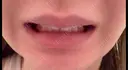 ボトックス（口角） BON BON CLINIC 渋谷院 DAY 2 サムネイル用