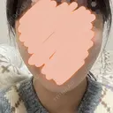 糸リフト / バッカルファット除去 / 脂肪吸引（顔） First Clinic AFTER サムネイル用