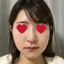 骨切り（あご） / 骨削り（エラ） / 骨削り（頬） / その他（輪郭） RG整形外科（旧リオン整形外科） DAY 15 サムネイル用