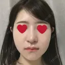 骨切り（あご） / 骨削り（エラ） / 骨削り（頬） / その他（輪郭） RG整形外科（旧リオン整形外科） DAY 20 サムネイル用