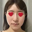 骨切り（あご） / 骨削り（エラ） / 骨削り（頬） / その他（輪郭） RG整形外科（旧リオン整形外科） DAY 38 サムネイル用