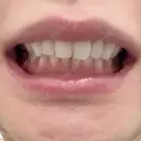 ボトックス（口角） BON BON CLINIC 渋谷院 DAY 3 サムネイル用