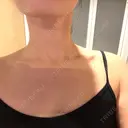 ボトックス（肩） / ワキ汗治療（ボトックス） APスキンクリニック銀座 AFTER サムネイル用