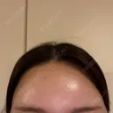 ヒアルロン酸注入（額） / ヒアルロン酸注入（こめかみ） Moon Beauty Clinic DAY 0 サムネイル用