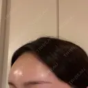 ヒアルロン酸注入（額） / ヒアルロン酸注入（こめかみ） Moon Beauty Clinic DAY 0 サムネイル用