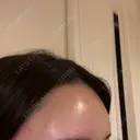 ヒアルロン酸注入（額） / ヒアルロン酸注入（こめかみ） Moon Beauty Clinic DAY 0 サムネイル用