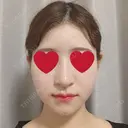 骨切り（あご） / 骨削り（エラ） / 骨削り（頬） / その他（輪郭） RG整形外科（旧リオン整形外科） DAY 43 サムネイル用
