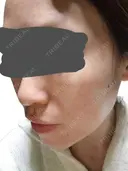 シワ取りボトックス / ピコレーザートーニング（美白・肝斑） / ピコフラクショナルレーザー（毛穴・ニキビ跡） 東京シルククリニック 東京神田院 DAY 0 サムネイル用