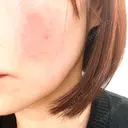 その他（輪郭） ルラ美容クリニック 大宮院 / ルラスキンクリニック 大宮院 AFTER サムネイル用