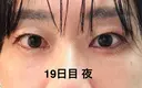 クマ治療 eクリニック 大阪梅田 西日本統括院 AFTER サムネイル用