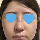 隆鼻術 / 鼻尖形成（切開） / 鼻中隔延長（切開） / 斜鼻修正 / 眉間プロテーゼ / その他（鼻） FROM B整形外科 (旧バウム整形外科) DAY 5 サムネイル用