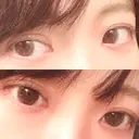 二重埋没 / 上まぶたの脂肪取り 東京ヒルズクリニック 新宿院 DAY 42 サムネイル用