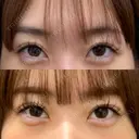 二重埋没 / 糸リフト / ヒアルロン酸注入（あご） ネビュラクリニック 京都院 AFTER サムネイル用