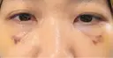 クマ治療 池袋麗歯科・美容皮膚科 DAY 14 サムネイル用