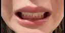 ボトックス（口角） BON BON CLINIC 渋谷院 DAY 4 サムネイル用