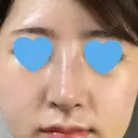 隆鼻術 / 鼻尖形成（切開） / 鼻中隔延長（切開） / 斜鼻修正 / 眉間プロテーゼ / その他（鼻） FROM B整形外科 (旧バウム整形外科) DAY 8 サムネイル用