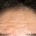 ボトックス（エラ・小顔） / ボトックス（眉間） / ボトックス（目尻） / ボトックス（額） ルラ美容クリニック 郡山院 AFTER サムネイル用