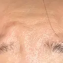 ボトックス（エラ・小顔） / ボトックス（眉間） / ボトックス（目尻） / ボトックス（額） ルラ美容クリニック 郡山院 DAY 1 サムネイル用