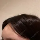 ヒアルロン酸注入（額） / ヒアルロン酸注入（こめかみ） Moon Beauty Clinic DAY 1 サムネイル用
