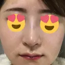 隆鼻術 / 鼻尖形成（切開） / 鼻中隔延長（切開） / 斜鼻修正 / 眉間プロテーゼ / その他（鼻） FROM B整形外科 (旧バウム整形外科) DAY 14 サムネイル用