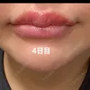 アートメイク（唇） / アートメイク（アイライン） Kinshicho Beauty Clinic （錦糸町ビューティークリニック） AFTER サムネイル用