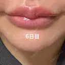 アートメイク（唇） / アートメイク（アイライン） Kinshicho Beauty Clinic （錦糸町ビューティークリニック） DAY 4 サムネイル用