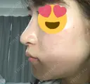 隆鼻術 / 鼻尖形成（切開） / 鼻中隔延長（切開） / 斜鼻修正 / 眉間プロテーゼ / その他（鼻） FROM B整形外科 (旧バウム整形外科) DAY 29 サムネイル用