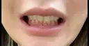 ボトックス（口角） BON BON CLINIC 渋谷院 DAY 5 サムネイル用