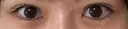 二重埋没 / 上まぶたの脂肪取り EMMA CLINIC（エマクリニック） AFTER サムネイル用