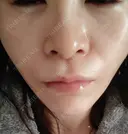 糸リフト 形成外科と美容外科のクリニック池袋 DAY 3 サムネイル用