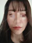 糸リフト 形成外科と美容外科のクリニック池袋 DAY 7 サムネイル用