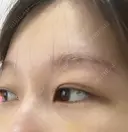 クマ治療 APOLLO BEAUTY CLINIC DAY 9 サムネイル用