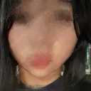 糸リフト / バッカルファット除去 / 脂肪吸引（顔） / ジョールファット除去 / ボトックス（エラ・小顔） アリエル美容クリニック 横浜院 DAY 8 サムネイル用